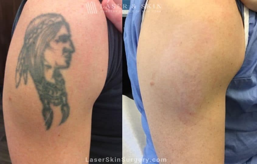 Best Tattoo Removal in NYC – Effective, Safe, Professional Solutions